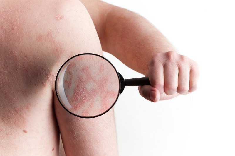Howsden Dermatology - Eczema
