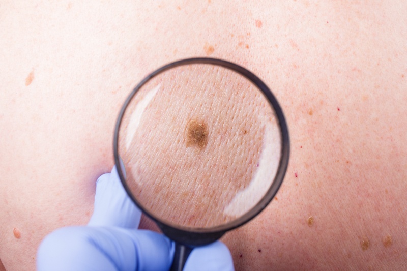 Howsden Dermatology - Skin Cancer