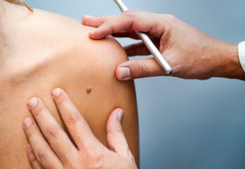 15271098963deeab4b skin cancer